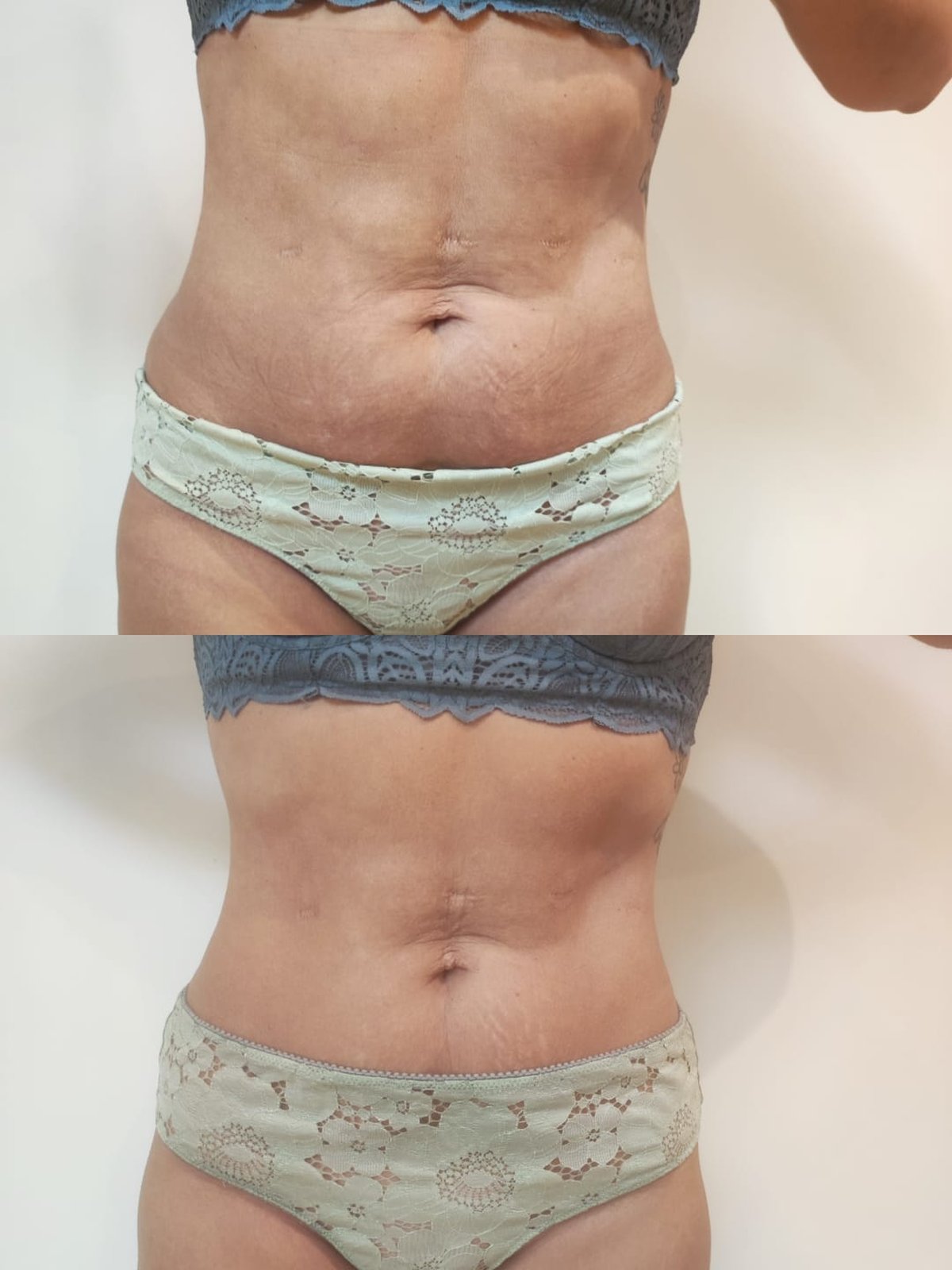 Avant/après drainage lymphatique silhouette